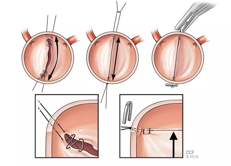 illustrations showing bicuspid aortic valve repair using the figure-of-8 stitch technique