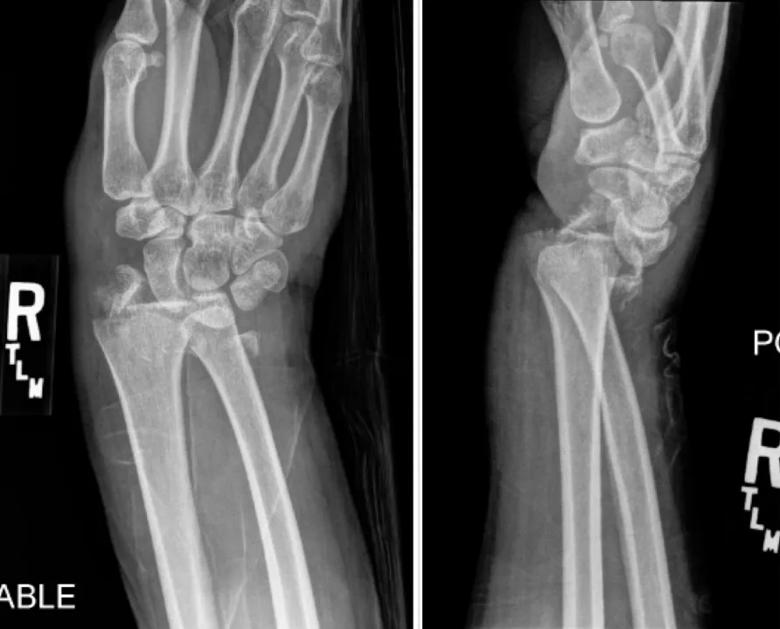 X-ray of broken wrist