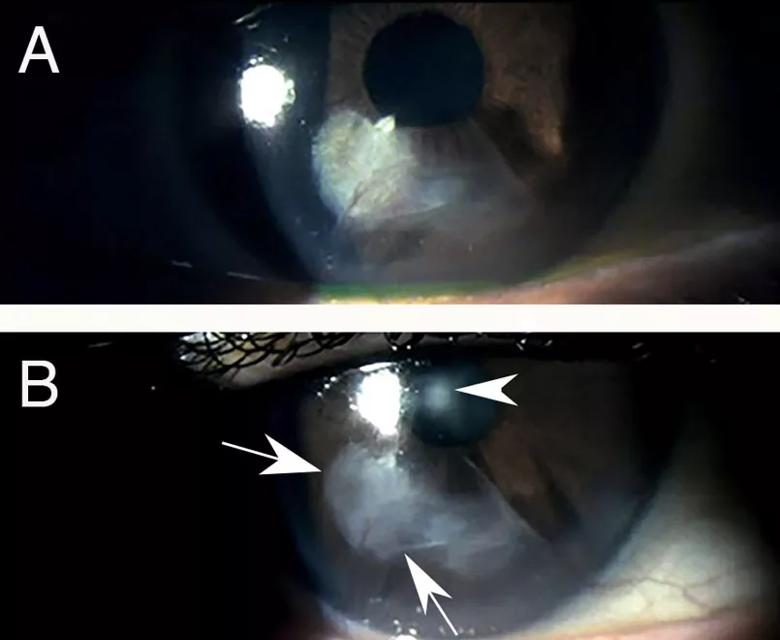 Topical losartan treatment of progressive fibrosis in a radial keratotomy incision