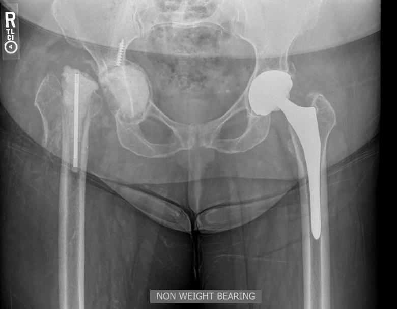 X-ray showing hip deformity