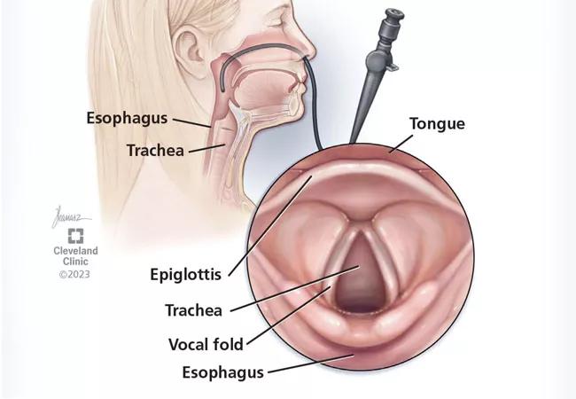 Flexible laryngoscopy is a routine otolaryngologic procedure typically performed in the office for visualization