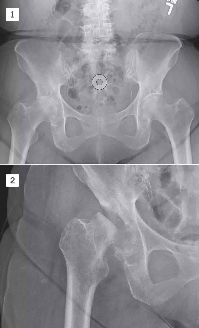 X-ray