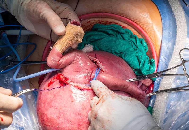 Dr. Cass begins to return the partially exteriorized fetus to the uterus. 