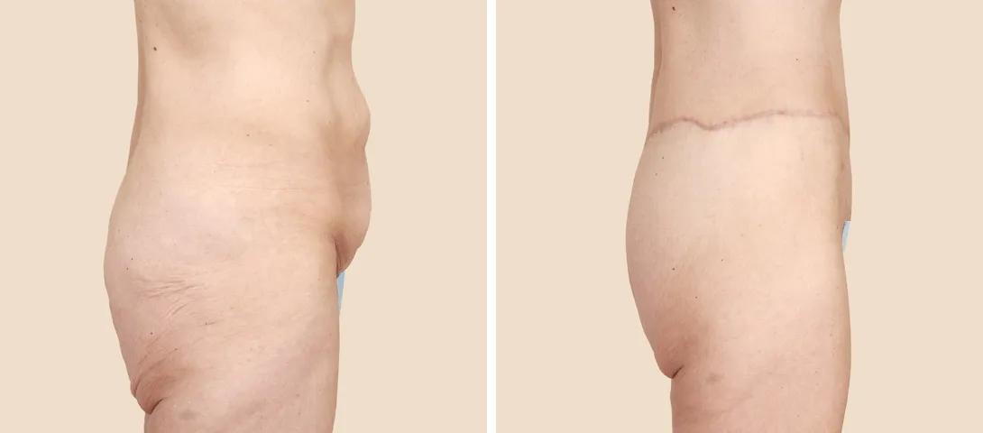 Before circumferential abdominoplasty (left) and 6 months after surgery (right).