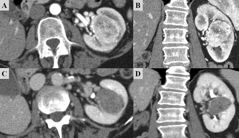 Patient imaging before and after TKI therapy 