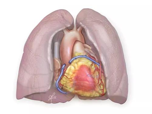 Figure 3. Completed combined CABG/double lung transplant.