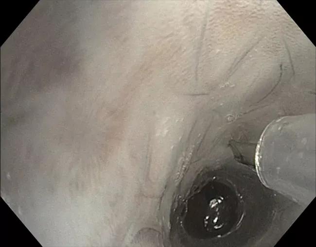 Stent