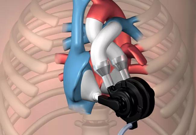 What's on the Horizon in Heart Failure Care and LVAD Technology?