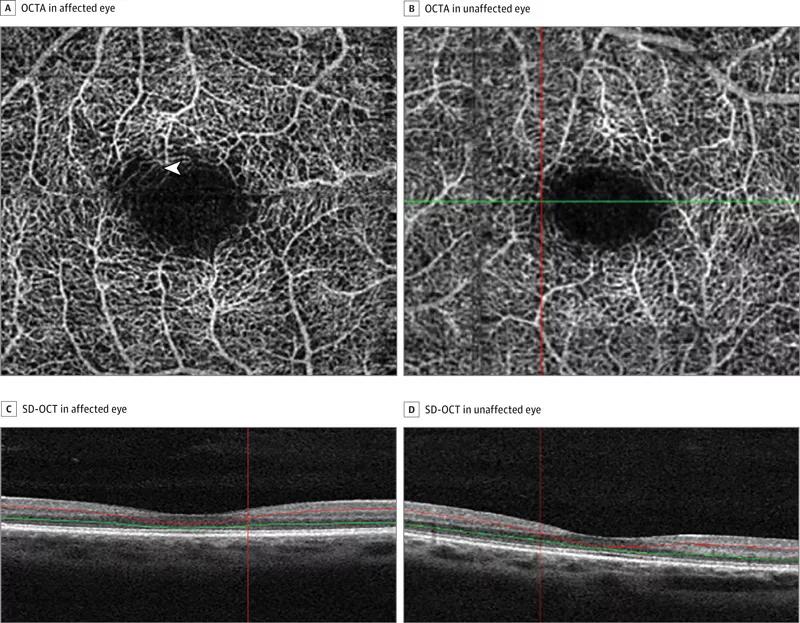 16-eye-1562-octa-cqd-fig1