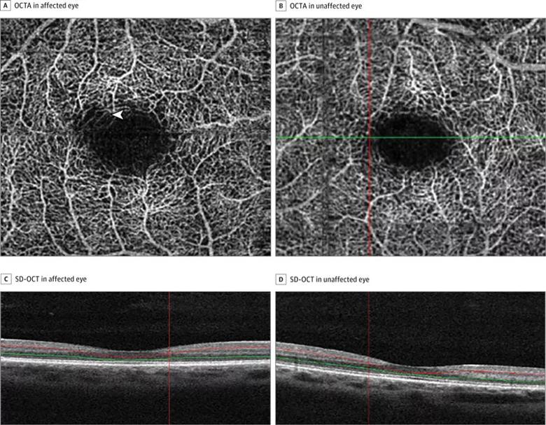 16-eye-1562-octa-cqd-fig1