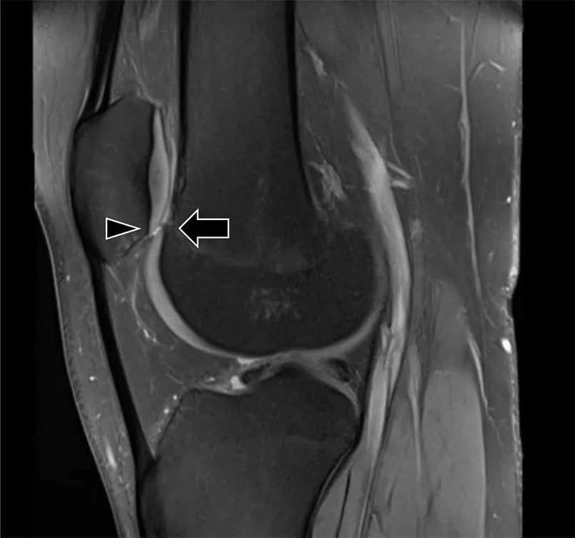 Image of patella alta 