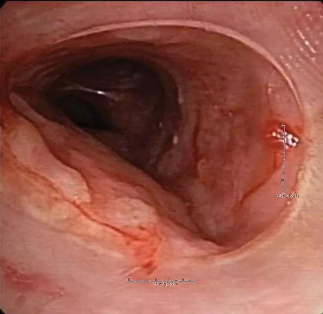 Left main bronchus.