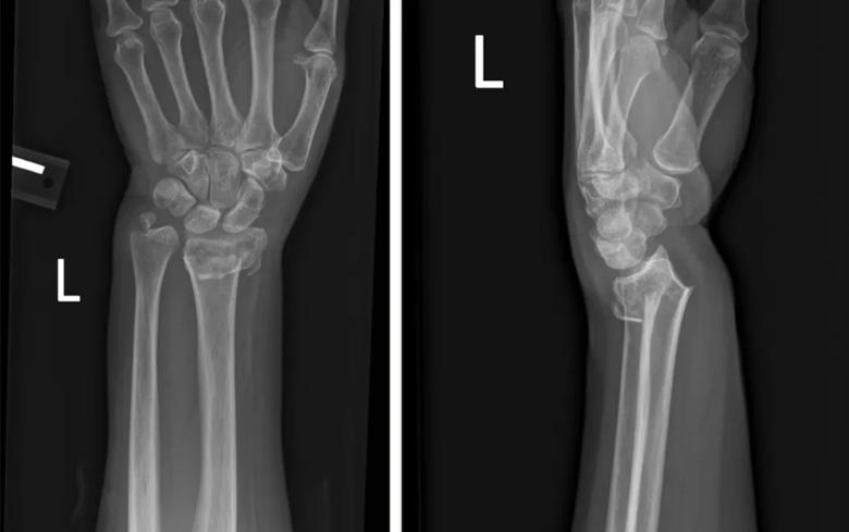 X-ray of broken wrist