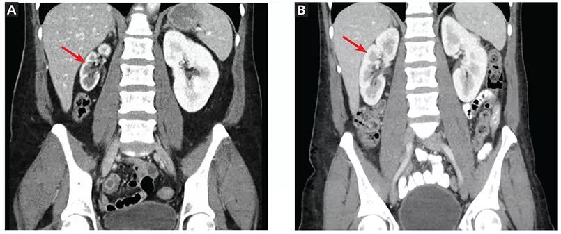 Computed tomography showing right kidney at presentation and one year later