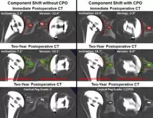 total shoulder arthroplasty