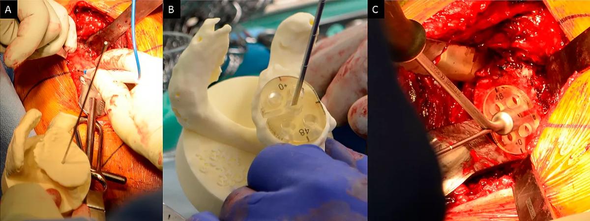 Shoulder surgery
