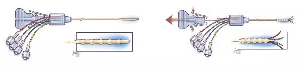 590x-Inset-1-Vogelbaum-Catheter