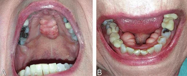 Top and bottom views of the mouth wide open to show bony and swollen bumps.