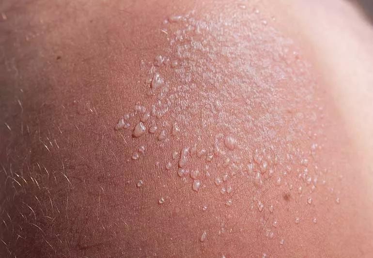 Home Remedies for Sunburn – HOO Dermatology