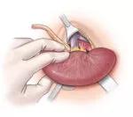 G. Externalization of graft from retroperitoneal pocket following completion of vascular anastomosis for hemostasis examination