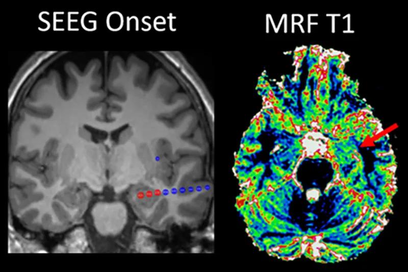 grayscale brain scan next to a colorful brain scan