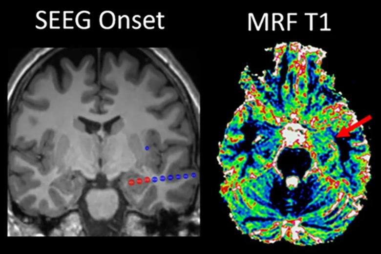 grayscale brain scan next to a colorful brain scan