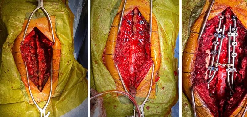 three photos of an incision in the back of a person having spine surgery