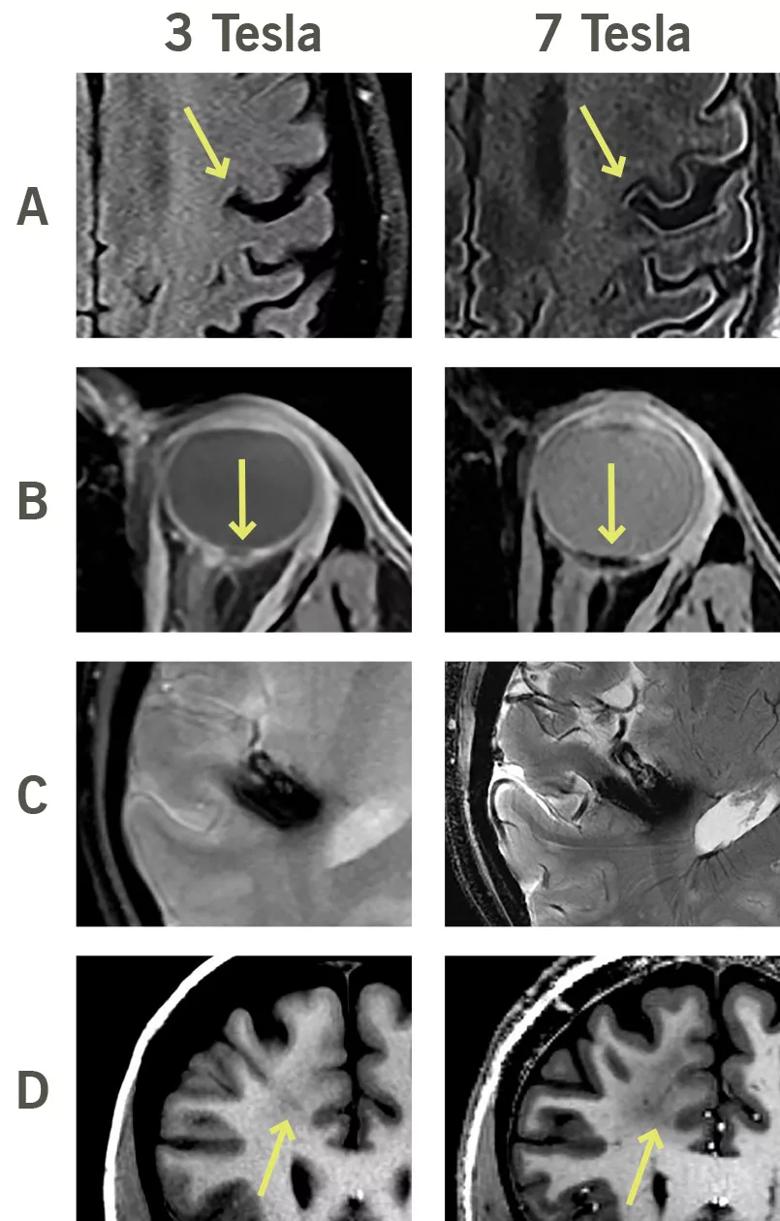 Figure. Comparative imaging studies at 3T and 7T. (A) Images of a patient with amyotrophic lateral sclerosis in which 7T reveals enhanced signal loss along the motor strip of the precentral gyrus. (B) Images of an orbital melanocytoma of the optic nerve head, with 7T clearly showing the relation of the tumor to the nerve head, an important detail for managing surgical treatment. (C) Images of a large cavernous malformation, with 7T revealing superior details of the lesion with respect to underlying anatomy. (D) Images demonstrating left frontal cortical dysplasia. Note how 7T clearly shows superior delineation of the subcortical lesion.