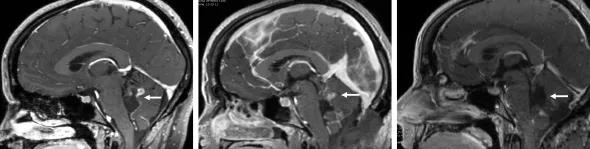 Figure. Series of MRIs in a recent pediatric patient demonstrating the utility of intraoperative imaging. Left: Preoperative image showing a cystic mass in the fourth ventricle with enhancing portion in the superior vermis (arrow). Middle: Intraoperative image showing residual tumor in the superior vermis (arrow) after cyst resection, prompting additional operative work to remove the residual tumor. Right: Postoperative image showing complete resection of the tumor (arrow). 