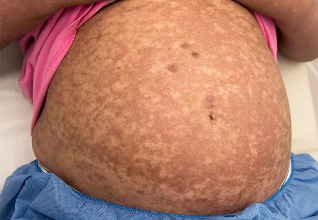 Pregnancy rash