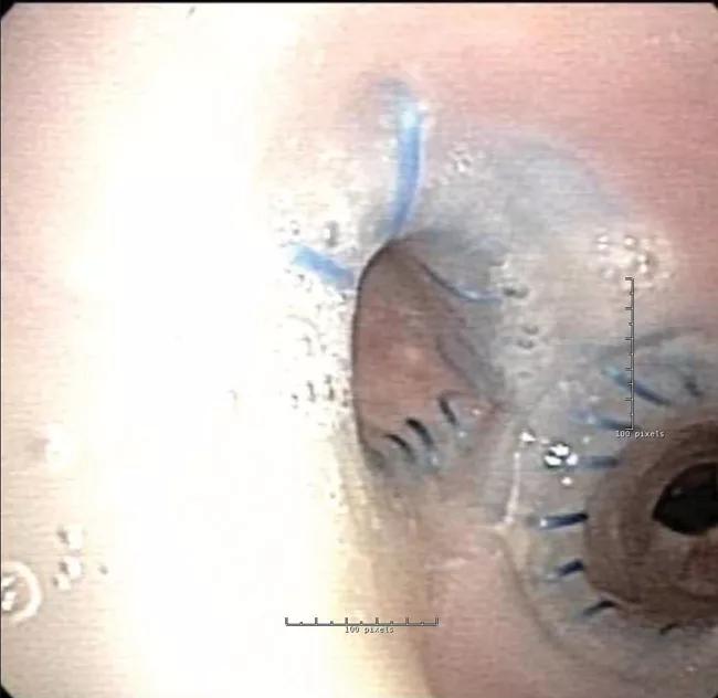 Customized Y stent.