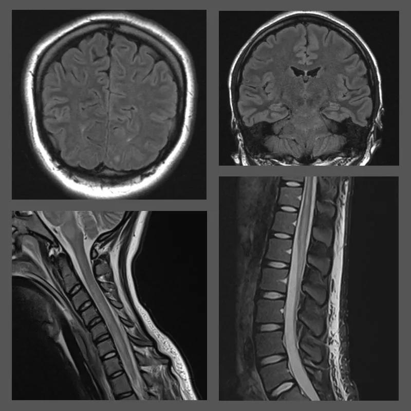 MRIs of brain and spine