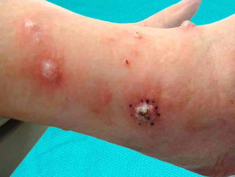 Eruptive squamous cell carcinoma keratoacanthomas in a patient receiving ruxolitnib for primary myelofibrosis.