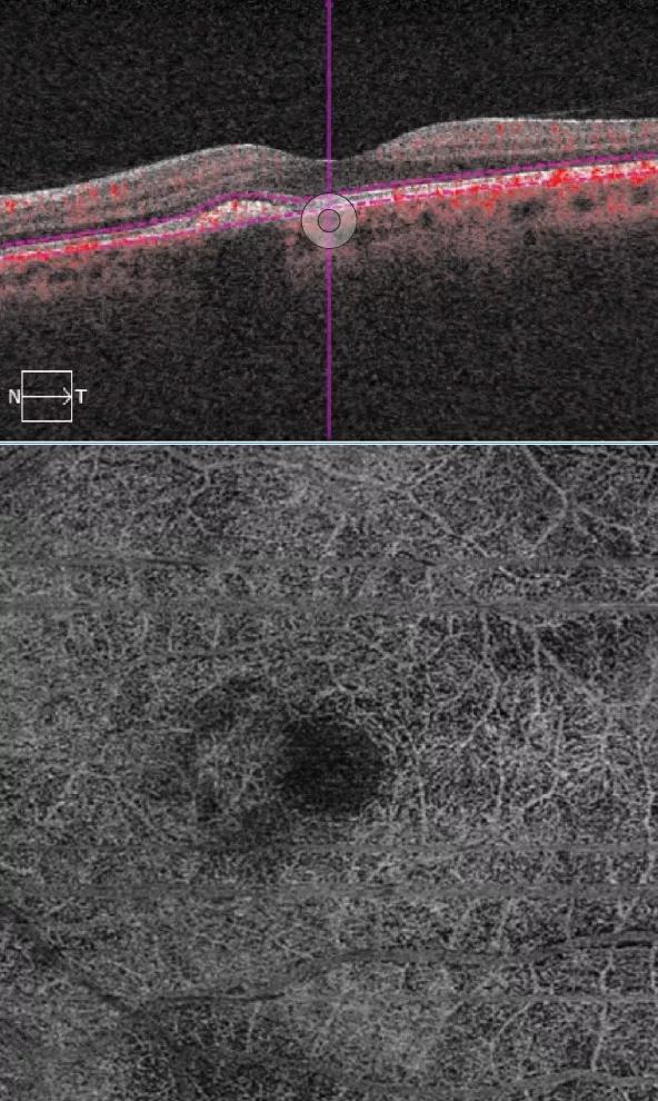 Eye