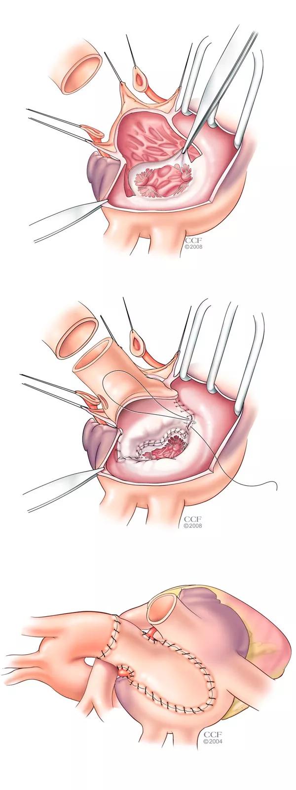 Illustrations of three stages of the hemi-commando procedure. 