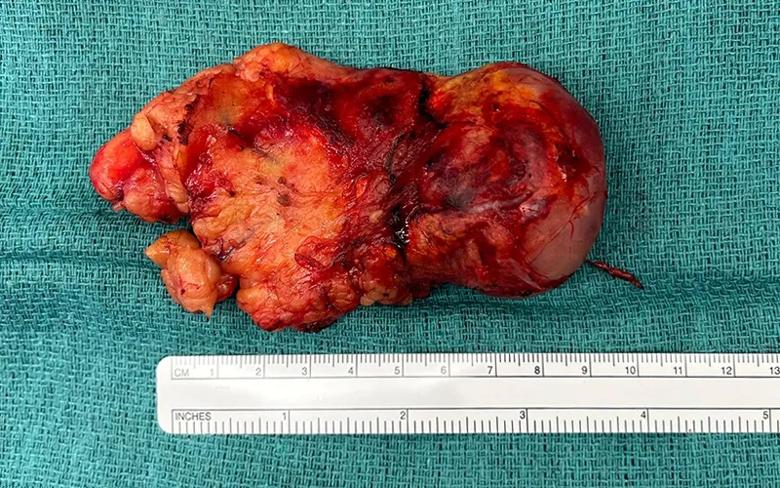 image of patient's resected pheochromocytoma