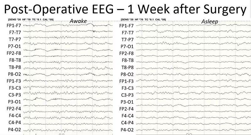EEG recordings