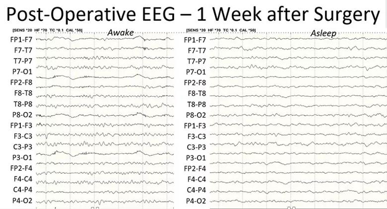 EEG recordings