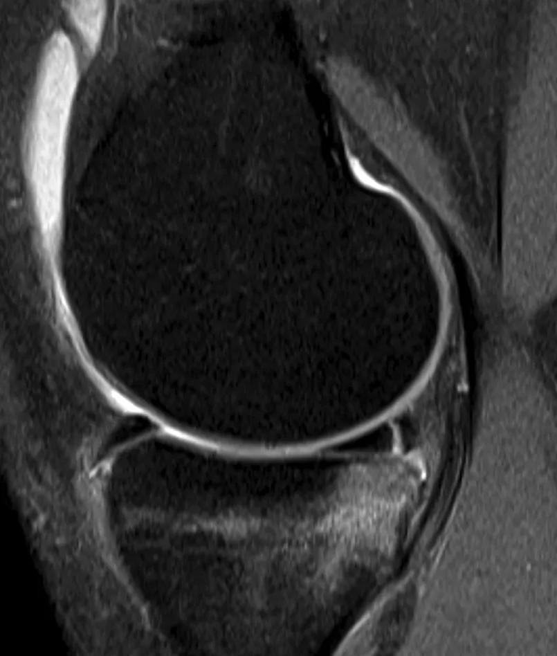 Sagittal MRI showing bruising to medial tibial plateau two weeks after ACL rupture.