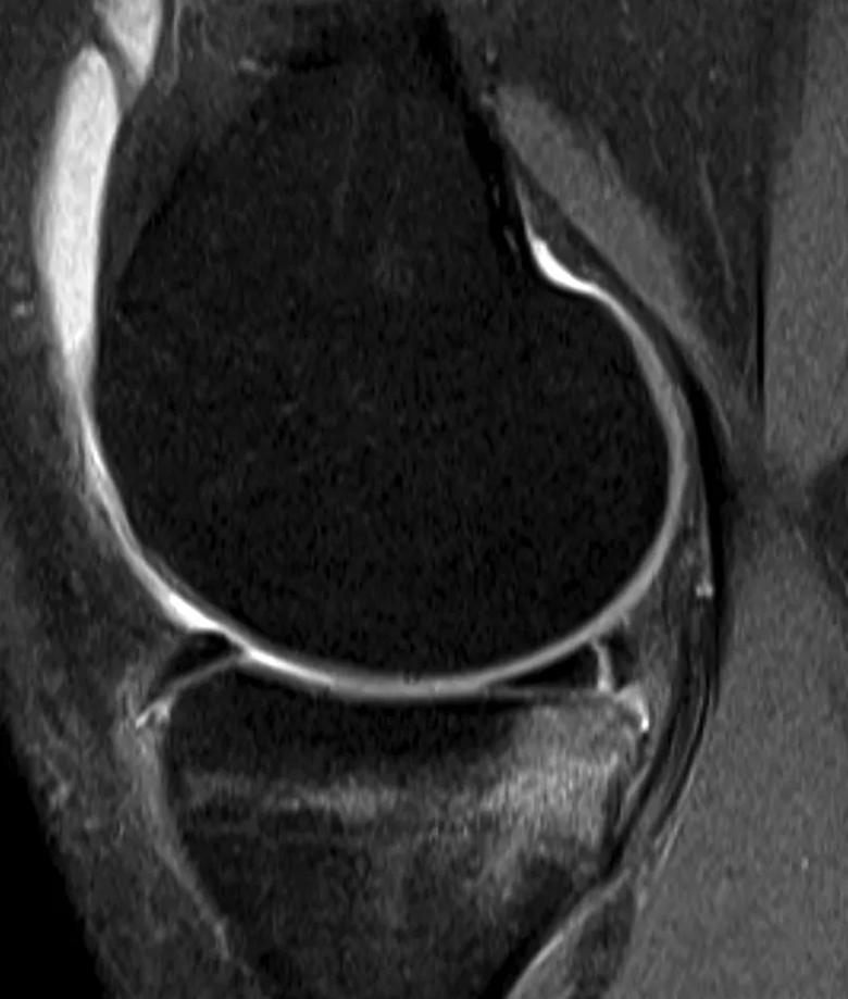 Sagittal MRI showing bruising to medial tibial plateau two weeks after ACL rupture.
