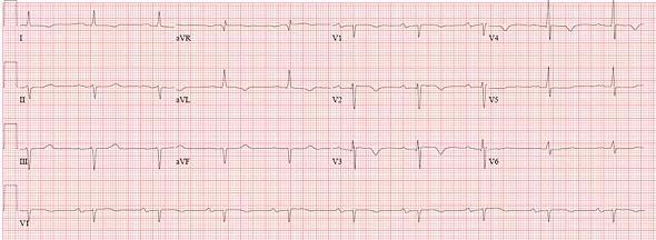 ECG from the case patient