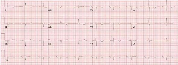 ECG from the case patient