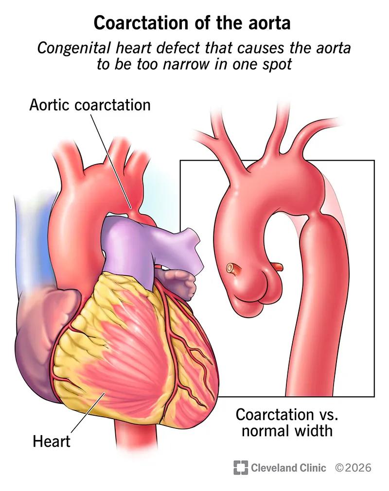 Heart anatomy with aortic coarctation, or narrowing of the aorta, in one spot