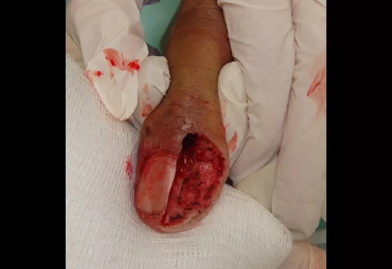 Close-up of finger during surgery