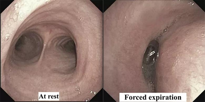 flexible bronchoscopy images