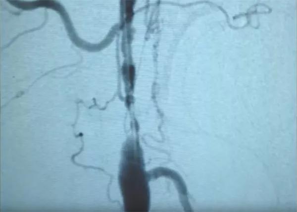 Critical Limb Ischemia 