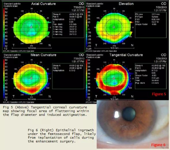 Enhancement 13 Years After Lasik