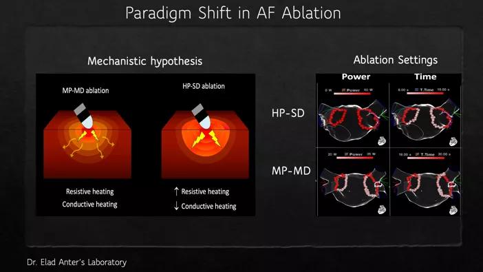 Visualization between high-power, short-duration (HP-SD) and moderate-power, moderate-duration (MP-MD) ablation strategies.