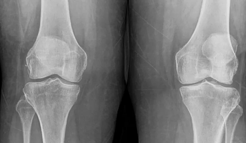 X-ray of a patient with early osteoarthritis