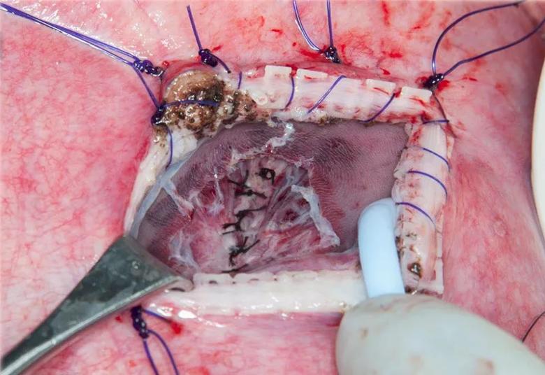 The placode is internalized; myofascia approximated; skin remains open during the repair.